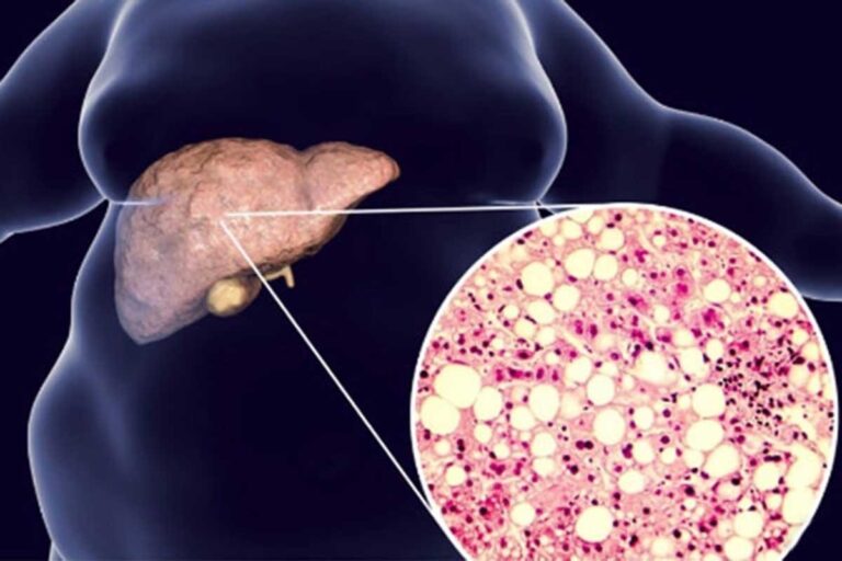 Masnu jetru ima i svaka peta mršava osoba: Ovo su podmukli simptomi koje ne smijete ignorisati Masnu jetru ima i svaka peta mršava osoba: Ovo su podmukli simptomi koje ne smijete ignorisati